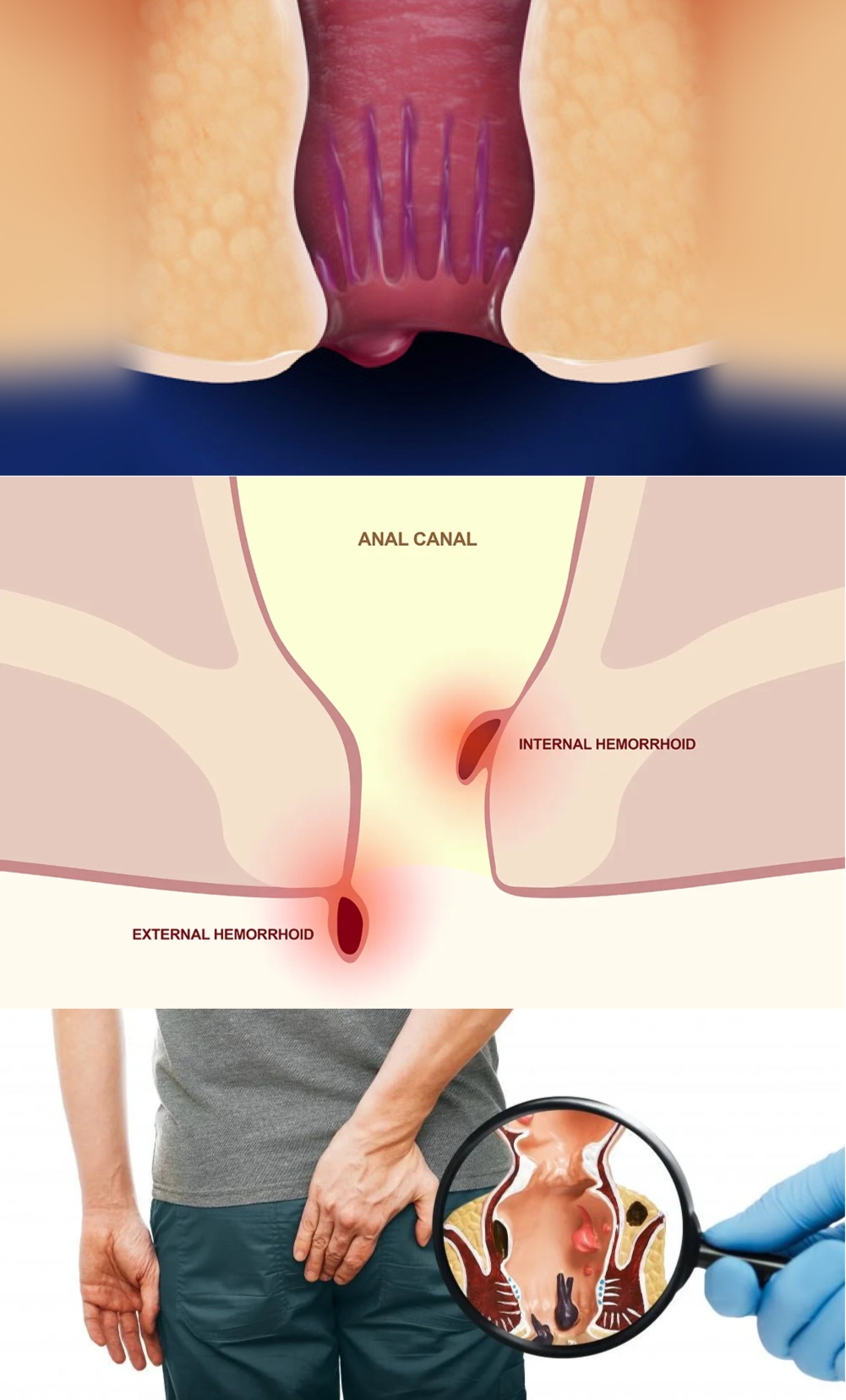 Fitolium natural remedy for hemorrhoids in India